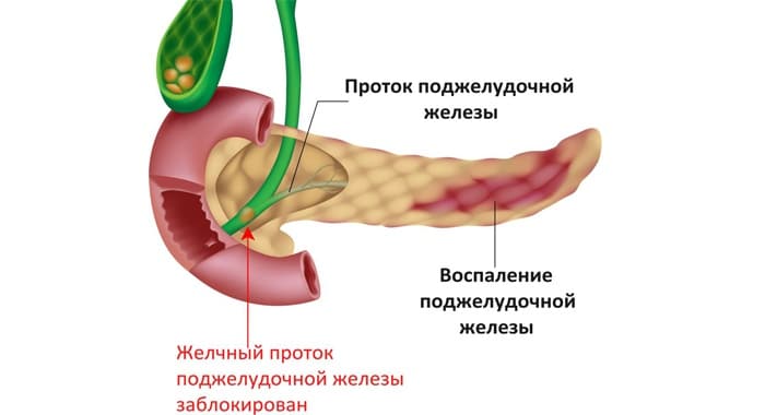 kogda-otekaet-podzheludochnaya-zheleza
